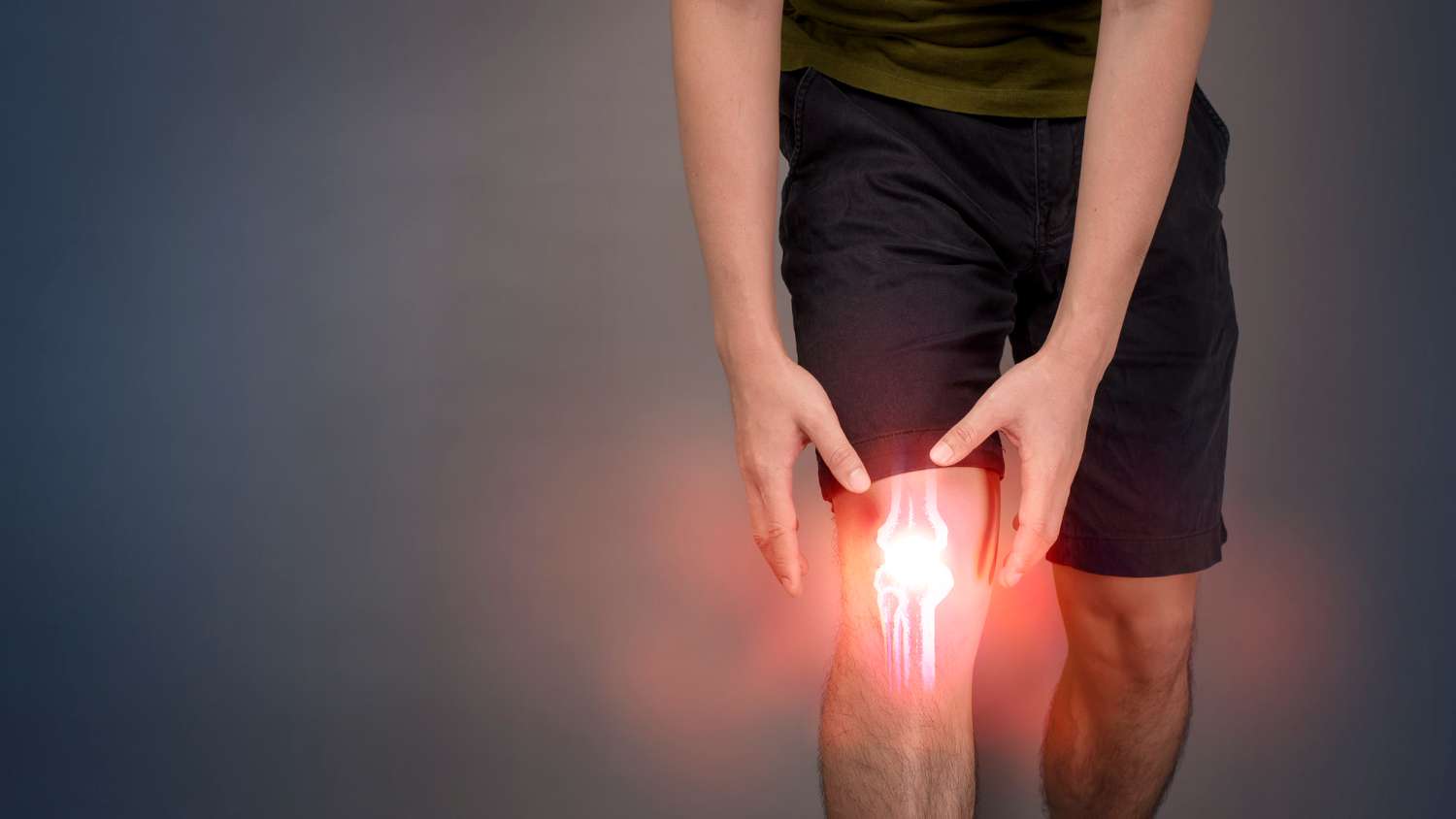 What are the 4 Stages of Osteoarthritis