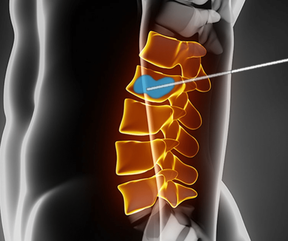 Is Kyphoplasty Permanent What You Should Know!